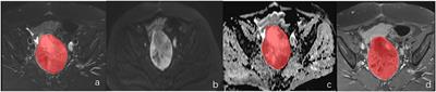 The Value of Magnetic Resonance Imaging Histograms in the Preoperative Differential Diagnosis of Endometrial Stromal Sarcoma and Degenerative Hysteromyoma